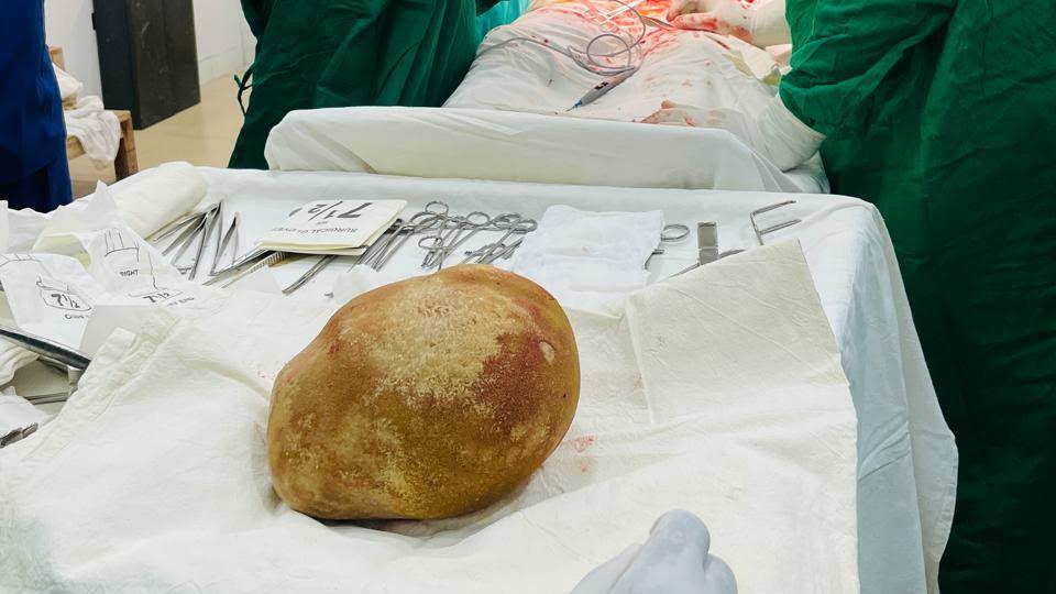 Sri Lanka Doctors Remove 3.1‑kg Bladder Stone, Claim Record‑Breaking Surgery